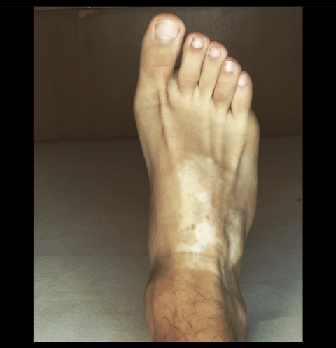 Vitiligo feets