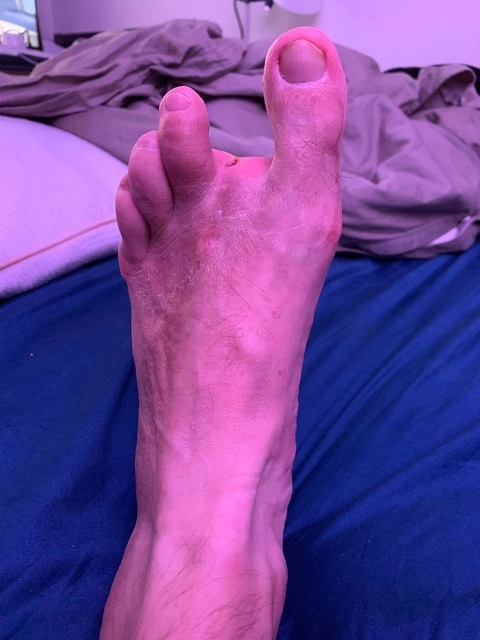 Andy’s strange foot